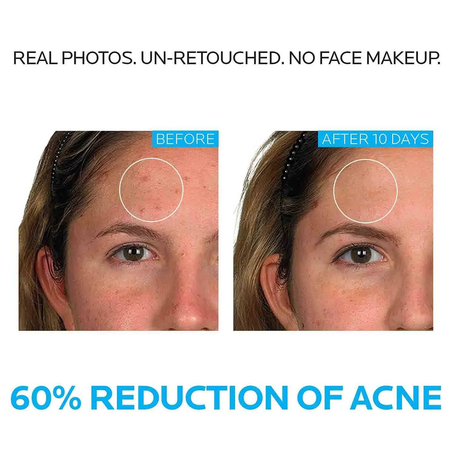 La Roche-Posay Effaclar 3 Step Acne Treatment System
